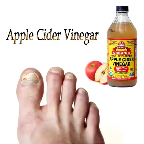 Apple Cider Vinegar Apple Cider Vinegar For Toenail Fungus