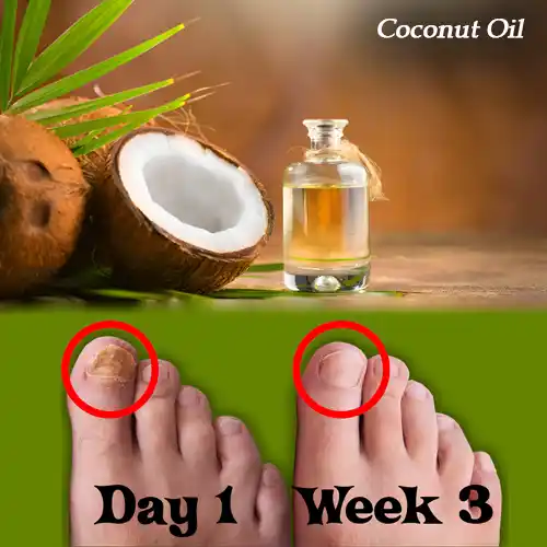 Coconut Oil Coconut Oil For Toenail Fungus