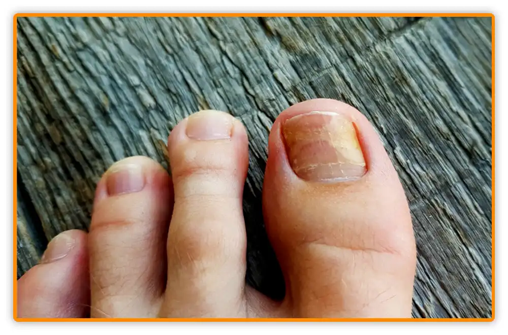 Early Signs on How to Know If Toenail Fungus is Dying Early Signs: How to Know If Toenail Fungus is Dying
