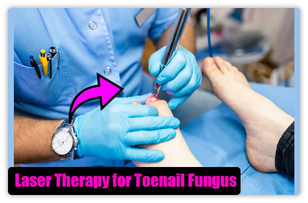 Laser Therapy for Toenail FungusLaser Therapy for Toenail Fungus Laser Therapy for Toenail Fungus