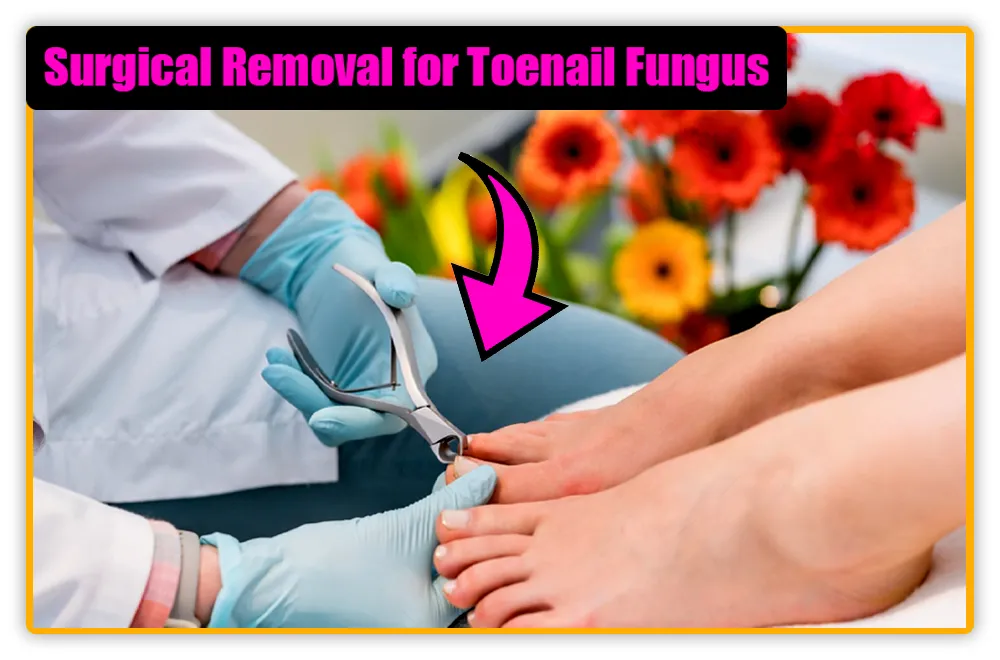 Surgical Removal for Toenail Fungus Surgical Removal for Toenail Fungus